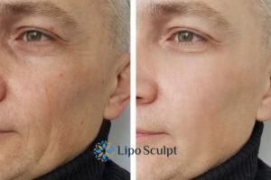 How to Fight Aging Symptoms 3 Fight Aging Symptoms Loughborough With HIFU and Morpheus8 Today!