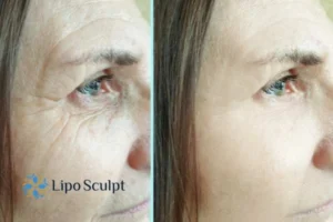 How to Fight Aging Symptoms 2 Do you want to Fight Aging Symptoms Loughborough? Contact Lipo Sculpt today!