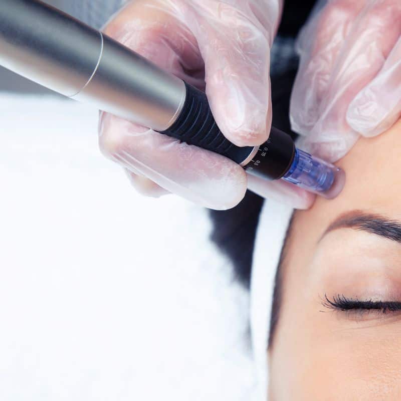 Morpheus8 treatment Loughborough from Lipo Sculpt - Book in today!