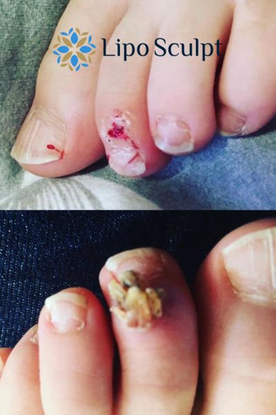 Wart removal customer results from Lipo Sculpt Loughborough