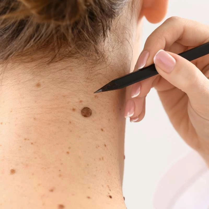 How to Support Your Body During Pregnancy for Faster Postnatal Recovery 5 See our lesion removal prices Loughborough - call today for a free quote