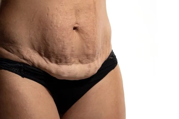 Lost the Weight but Not the Loose Skin? 1 image of womans stomach after weight loss showing loose skin Loughborough